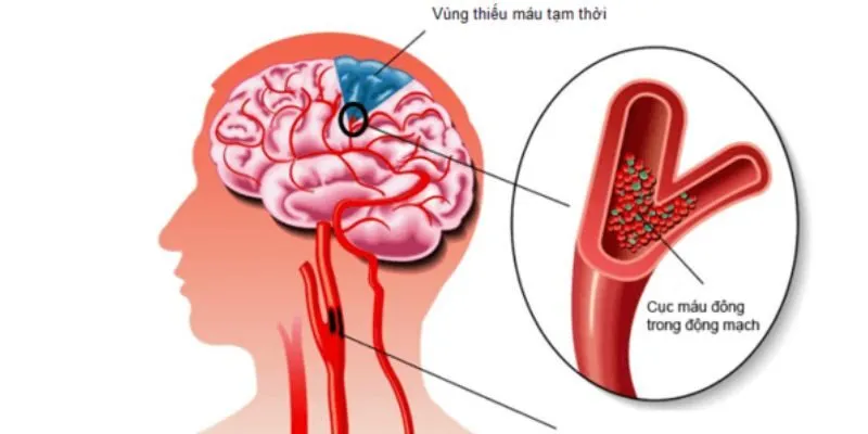 Bệnh rối loạn tiền đình